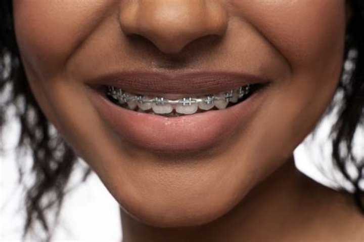 Can I get free braces at 18?