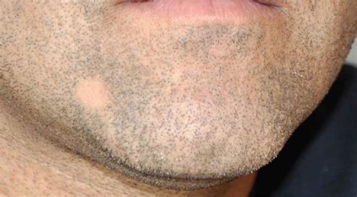 Can I grow hair in bald spots?