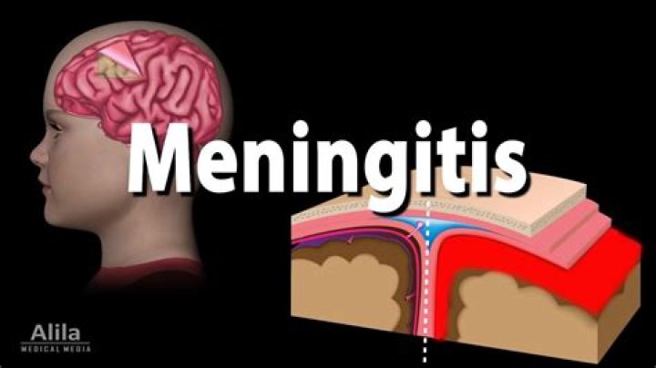 Can you die from spinal meningitis?