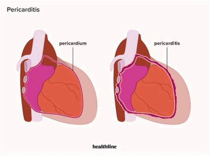 Does pericarditis hurt to touch?
