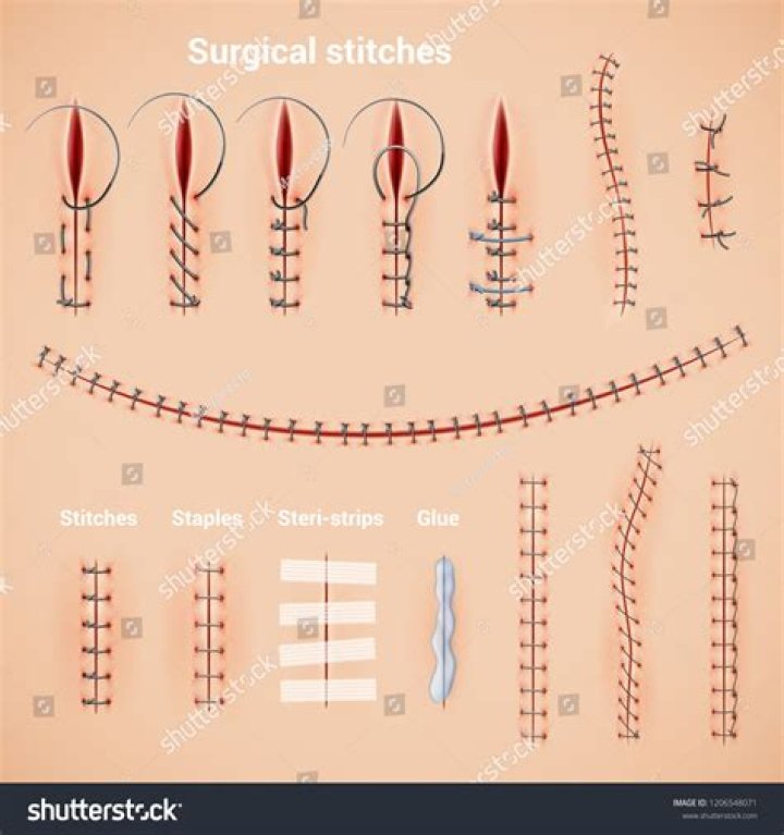 Does stitches count as surgery?