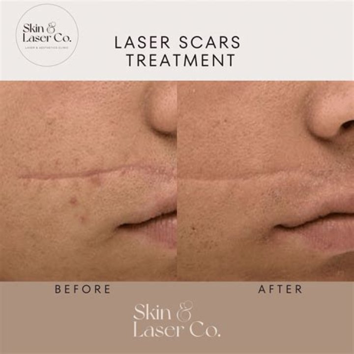 How can I improve my facial scars?