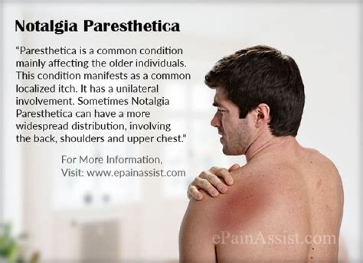 How common is Notalgia Paresthetica?