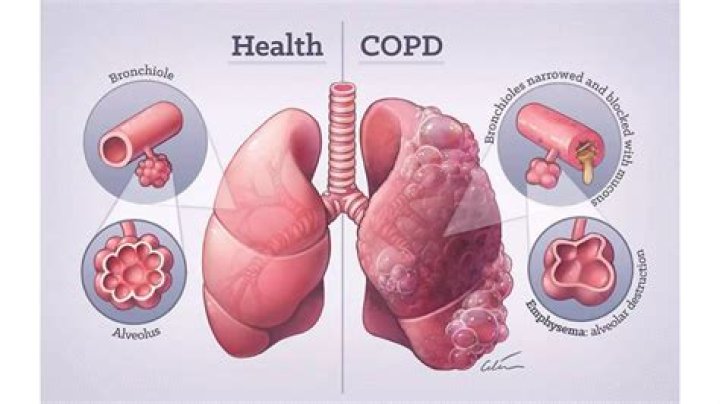 How do you educate a patient with COPD?