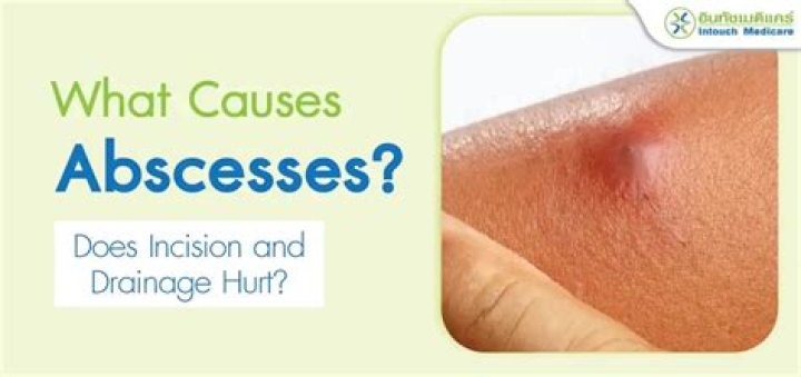 How do you know when an abscess is healing?
