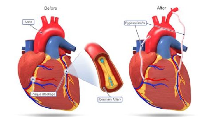 How Long Does your chest hurt after bypass surgery?