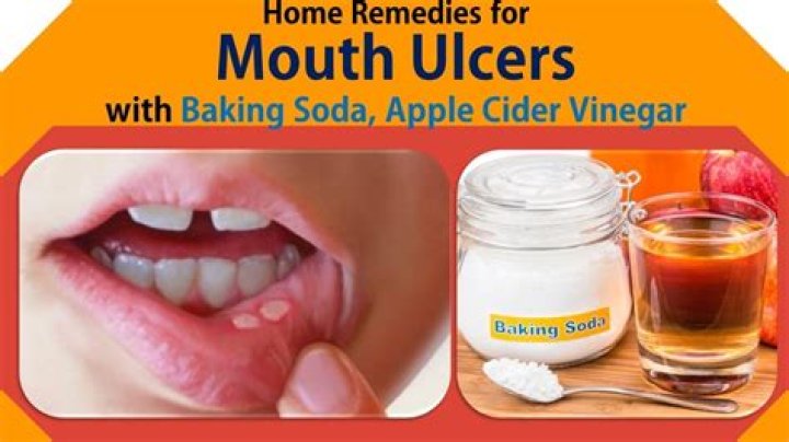 Is baking soda good for ulcers?