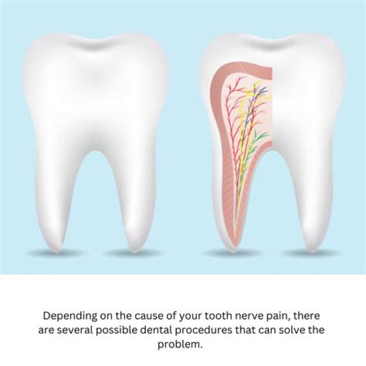 Is removing tooth nerve painful?