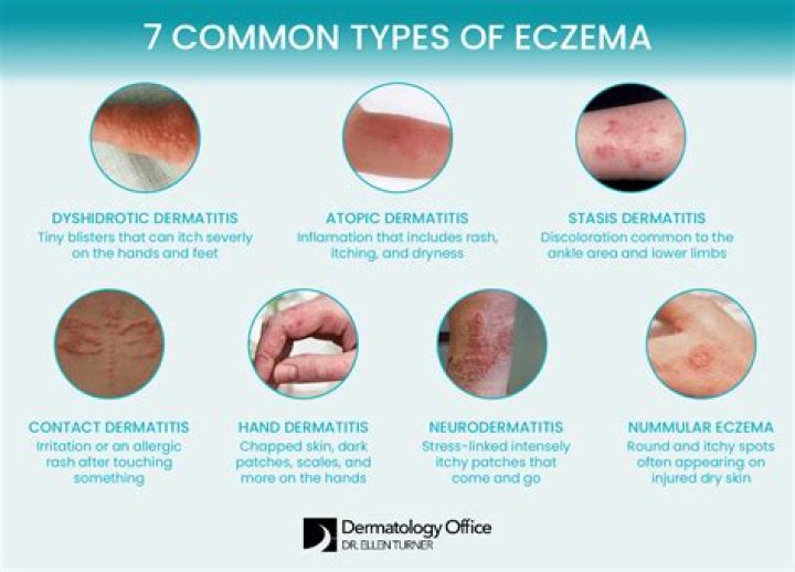 Should I pop eczema blisters?