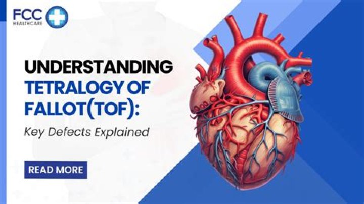 What are the four defects in tetralogy of Fallot?
