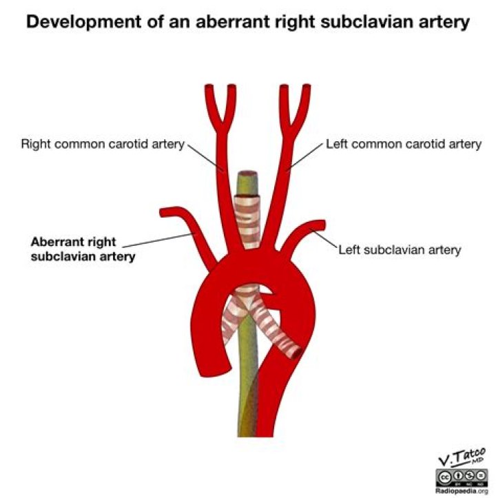 What causes aberrant right subclavian artery?