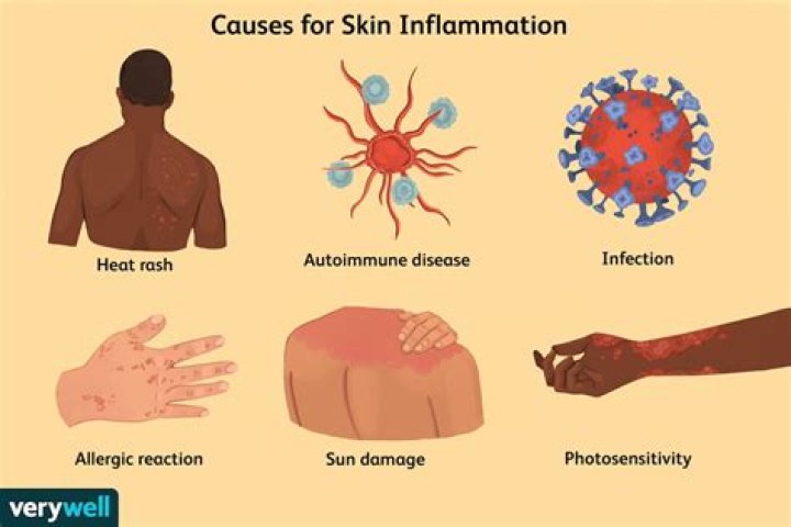 What causes the redness in inflammation?