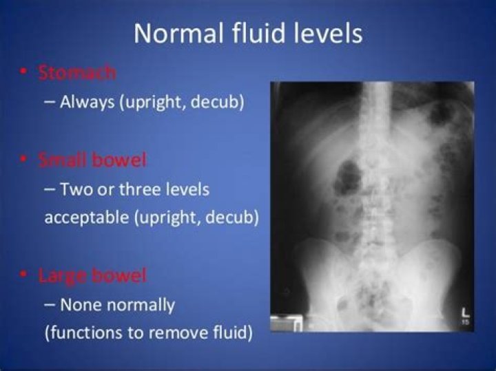 What do air fluid levels indicate?