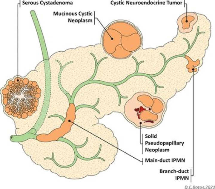 What happens if the cystic duct is blocked?