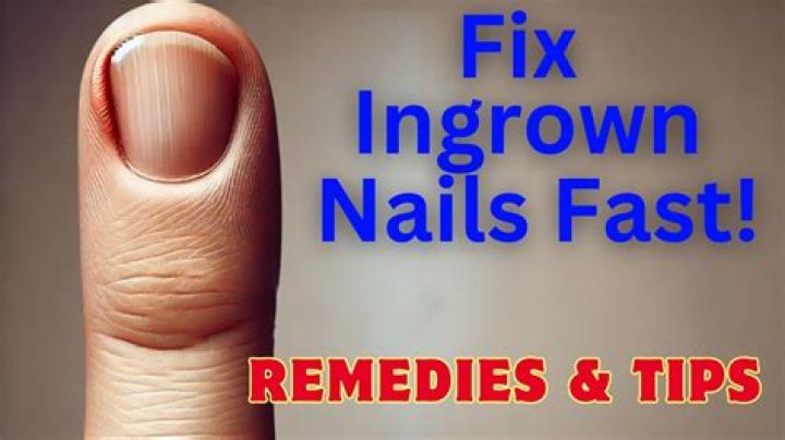 What is a ingrown fingernail?