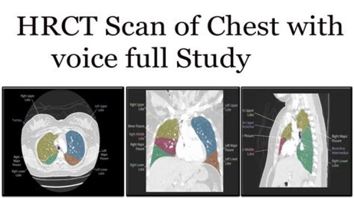 What is HRCT chest test?