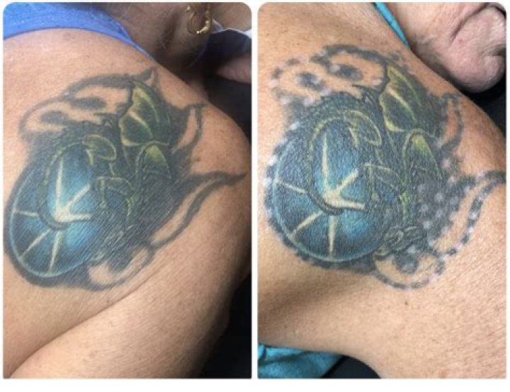 What is the best way to remove a tattoo?