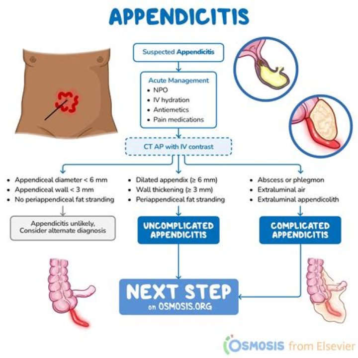 What should I do if I suspect appendicitis?