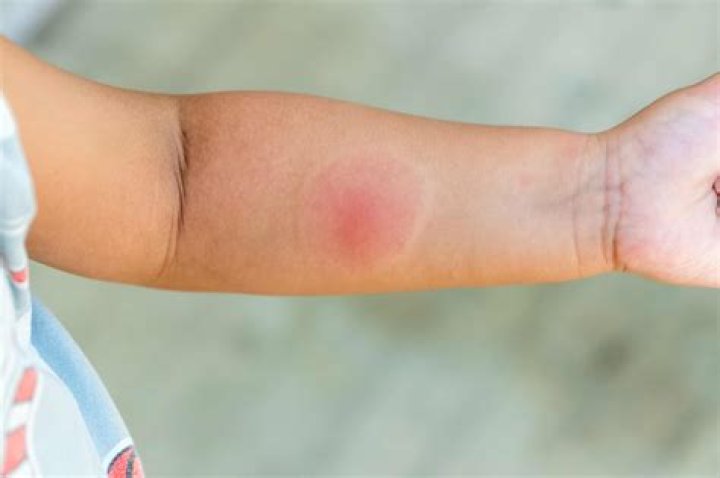 When should I be concerned about a mosquito bite?